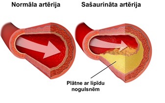 arterija